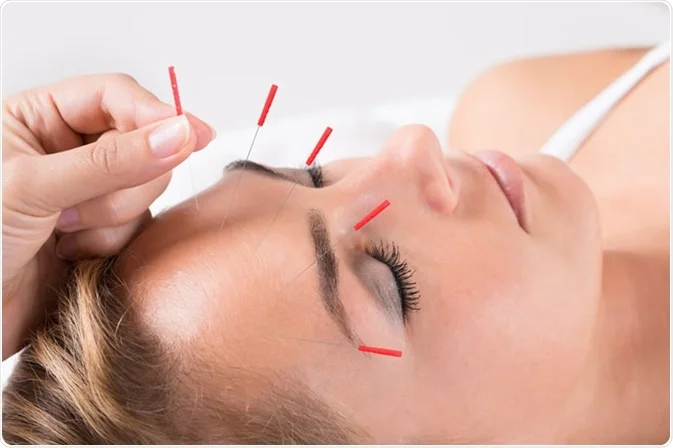 The Healing Art of Acupuncture in Cambridge